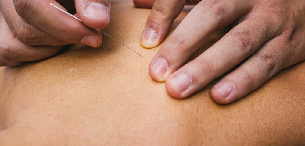 Physiotherapy Treatment Dry needling